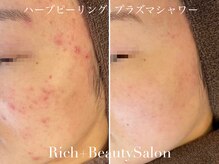 リッチ(Rich+)の雰囲気（ハーブピーリング+プラズマシャワーの効果で綺麗に★）