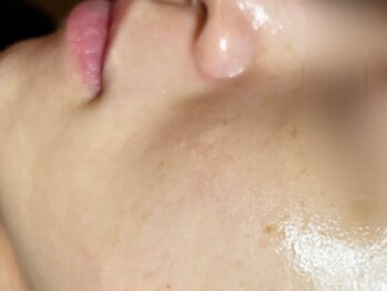 ミ コラソン(mi corazon)/アナナスフェイシャル