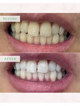 シカホワイトニングトウキョウ 笹塚店(CICA Whitening Tokyo)/ビフォーアフター(30代女性）