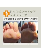フスフレーゲ 学芸大学店/何度もできるタコ・ウオノメ