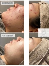 ラヴィオーラ 梅田店(La Viora) ハープ ピーリング