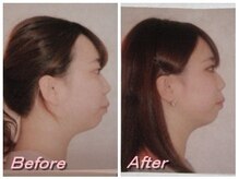 ドクター ヴィーナス/顎下のお肉がスッキリ！