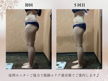 “落ちづらいところ”から狙い撃ち【脂肪冷却】\27,500→\5,500