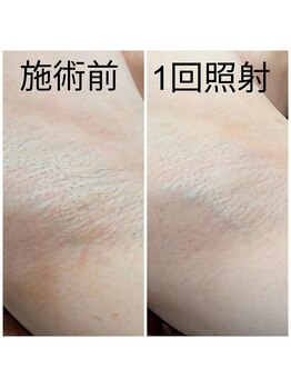 エミナル(EMINAL)/脇脱毛の効果!脱毛/毛穴/脱毛機