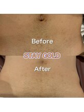 ステイゴールド 新百合ヶ丘(STAY GOLD)/ギャランドゥー！へそ下脱毛