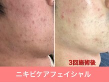 ミスターアンクール 鹿児島(Mr.uncoeur)/おまかせ肌ケア3回施術後