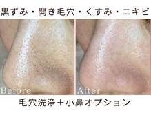 リリアン(lirien)/毛穴/毛穴ケア/毛穴洗浄/駒込