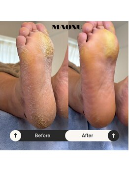 マオヌー(MAONU)/韓国式足裏角質ケア　症例写真