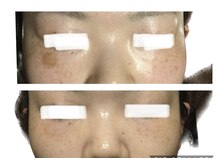 ドクターピュールボーテ 神戸店(Dr. PUR BEAUTE)/シミケア