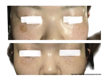 ブリエールラミール/シミケア