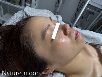 ナチュールムーン(Nature moon.)/ハーブピーリング &nbsp;after