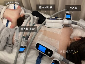レナータ 新宿店(RENATA)の写真/【結果重視！】脂肪冷却 全身８カップ美しいカラダ作り★結婚ブライダルエステにも当店大人気！