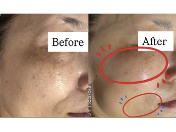 サロン ド モナ(salon de mona)の写真/【40代本気のエイジングケア】ハイパーナイフ×集中パックで気になるフェイスラインをキュッと引き締め