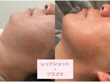 サロンドリー(salon de Re)の雰囲気（[レッドショット/リフトアップ/エイジングケア/たるみケア/小顔]）