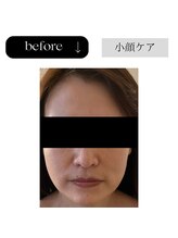 アイチューズ(ICHOOSE)/口元のゆるみ・むくみは老け顔に