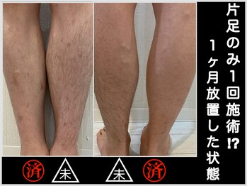 ファシネイト 新宿本店(Fascinate)/片足のみ脱毛！生えるスピードが