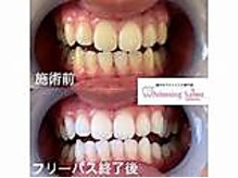 エクシアホワイト 立川南口店/セルフホワイトニング