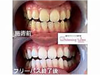 エクシアホワイト 立川南口店/セルフホワイトニング