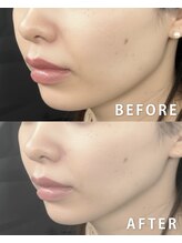 レモンスタジオ(Lemon studio)/韓国肌管理｜秩父 Vリフト・小顔