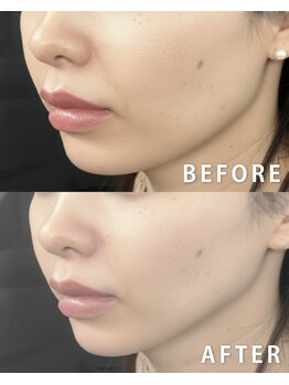 レモンスタジオ(Lemon studio)/韓国肌管理|秩父 Vリフト・小顔