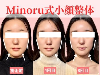 フレキシボディ(FlexiBody)/小顔施術ビフォーアフター #14