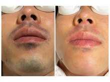 ヴァイオス 新宿店(VIOS)/◆ヒゲ脱毛【before/after】