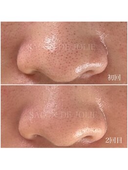 サロンドジョリー/このタイプの毛穴にはピーリング