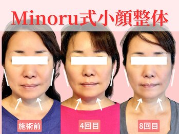 フレキシボディ(FlexiBody)/小顔施術ビフォーアフター #15