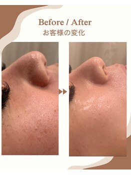 トゥーセブンネイルズ(TwoSevenNails)の写真/【本気のエイジングケア】シミ/シワ/たるみ/毛穴ケアを最新ヒト幹細胞導入でリフトアップの艶肌エステ！