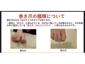 とくしま整体院 藍住院/巻き爪