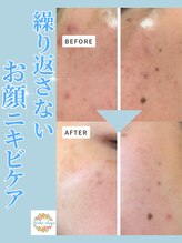 ラウレア オハナ(Laulea ohana) 肌改善 ニキビケア