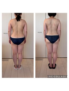 ハートエルボー(Heart elbow)/月１回を半年間