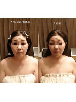 アンジュ/ウルトラリフト/たるみケア小顔