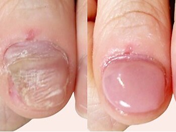 ココモ(cocomo)の写真/深爪矯正で美しいネイルを実現/長さだしとフィルインで長持ち仕上げ/違いをぜひお確かめください♪