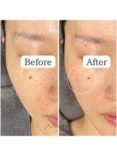 サロン ウーカ(salon WOOCA)/シミケアペン【シミ】