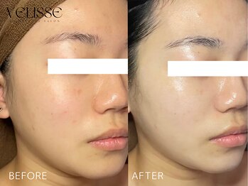 Velisse 表参道店【ヴェリス】《毛穴/肌質改善/ハーブピーリング/ニキビケア》/