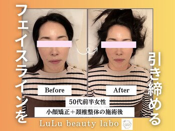 ルルラボ(LuLu beauty labo)/下顔面がスッキリ！