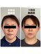 森のハナレ ユキケアサロン(YUKI care SALON)の写真/骨格エステで小顔になる！左右対称が美しいお顔です。むくみも取れて小顔に、さらに美肌へと変わります♪

