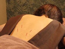 リ フリー 宮の森店(Re'free)/繰り返す腰痛には鍼灸がオススメ