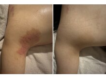 マハロ(mahalo)/掻いてしまう人にも施術できます