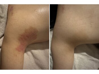 マハロ(mahalo)/掻いてしまう人にも施術できます