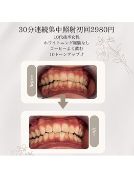 プラスビーセルフ(+b self)/ホワイトニングビフォーアフター