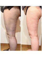 ヒーリングリゾート ナゴミ(Nagomi)/【脂肪冷却×電磁パルス】