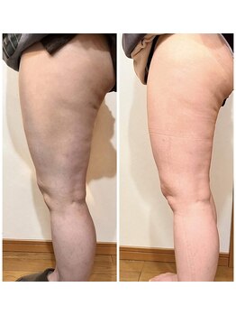 ヒーリングリゾート ナゴミ(Nagomi)/【脂肪冷却×電磁パルス】