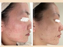 ルウス(Ruusu)/繰り返す肌荒れも