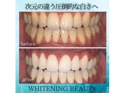ホワイトニング ビューティー 山梨の写真