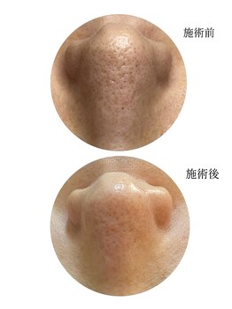 トイ(Toi)/背中~整えるから毛穴ケアが続く