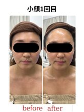 ステラ(Stella)/小顔1回で変化