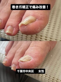 巻き爪じゅん 船橋店/巻き爪矯正で痛みを解消！