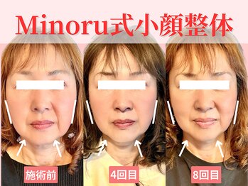 フレキシボディ(FlexiBody)/小顔施術ビフォーアフター #16